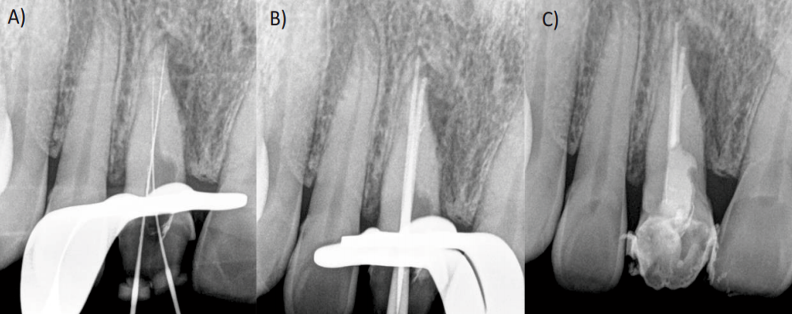 A) Radiografía intraoperatoria donde se observa el conducto completamente desobturado y la  determinación de la longitud de trabajo. B) Prueba de punta principal C) Radiografía postoperatoria  inmediata.