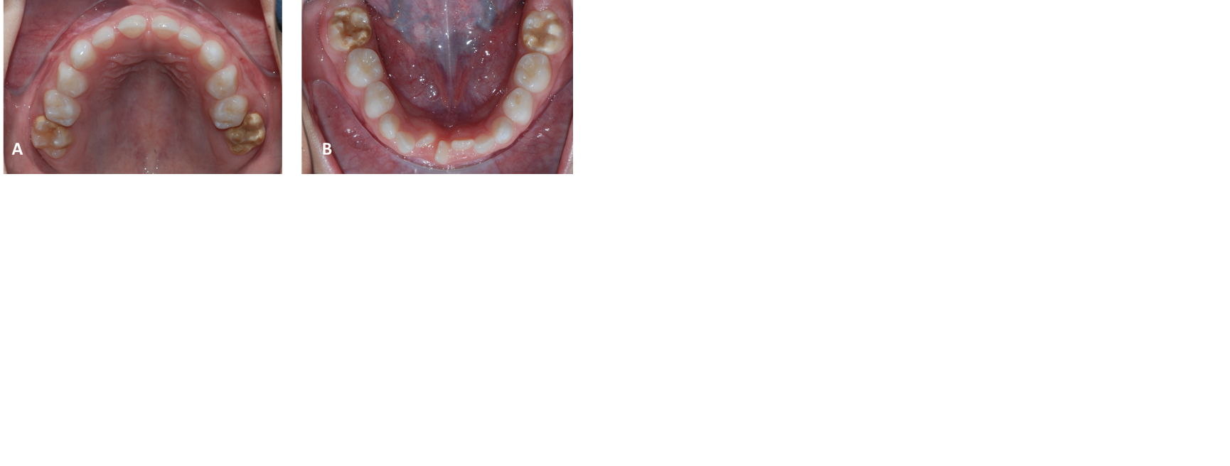 2A. Marcada opacidad y coloración amarillo marrón en caras oclusales y tercio medio coronal y fracturas post  eruptivas en UD 1.6 y 2.6. 2B. Preparaciones cavitarias sin material de obturación y fracturas post eruptivas en cúspides de UD 3.6 y 4.6.